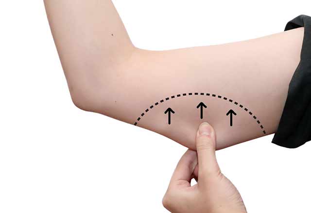 Liposuction nedir, nasıl uygulanır? – Estetik Haberleri