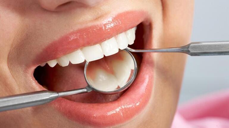 Bu maddeye dikkat Dişleri beyazlatmak yerine zarar veriyor