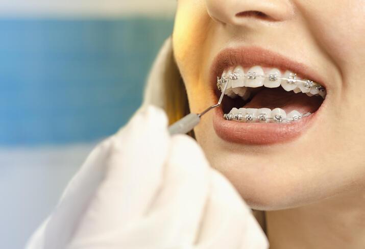 Diş Teli Fiyatları 2021: Şeffaf Plak, Lingual, Porselen ve Metal Diş Teli Fiyatları Ne Kadar?