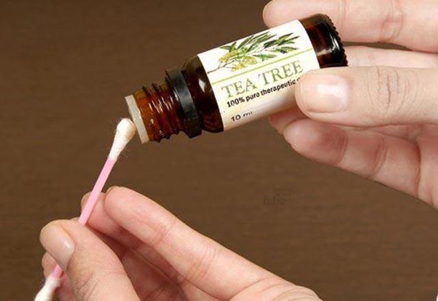 Uçuğa ne iyi gelir, nasıl geçer Uçuğu ne geçirir Uçuğu evde geçiren doğal yöntemler