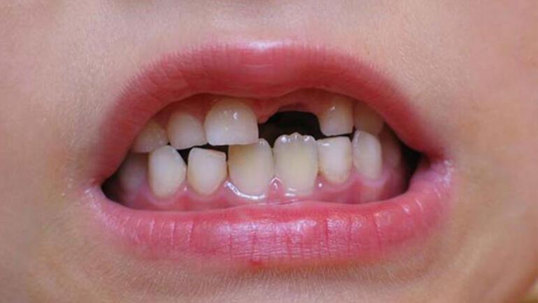 Çocukları süt dişi çürüklerinden korumak için 5 öneri