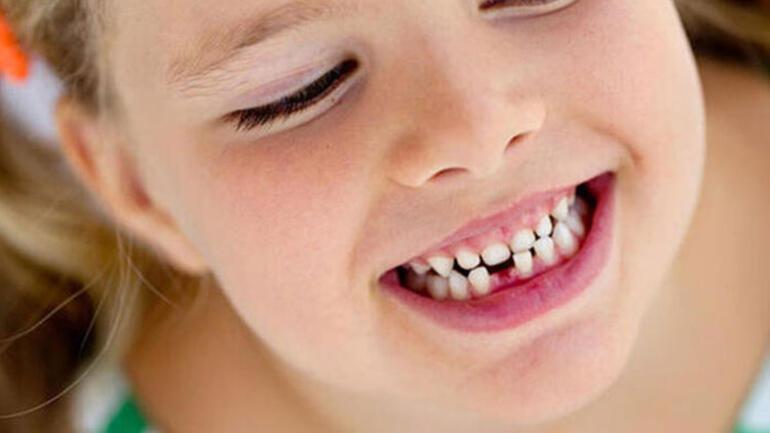 Çocukları süt dişi çürüklerinden korumak için 5 öneri