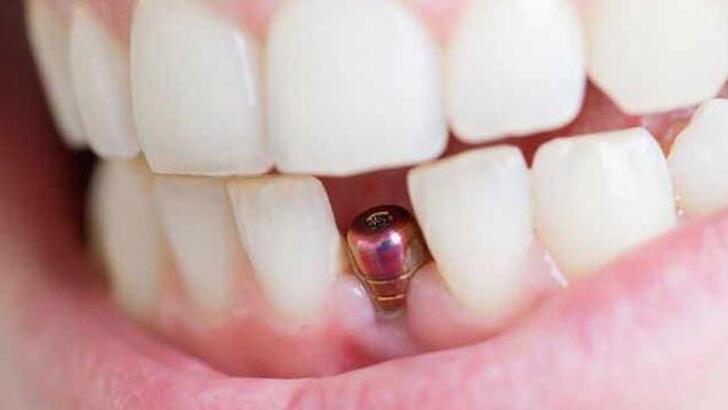 Diş implantları ile gerçek diş arasında bir fark var mı?