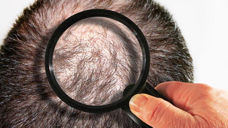 Saç ekiminde bilinmesi gereken olmazsa olmaz 10 doğru