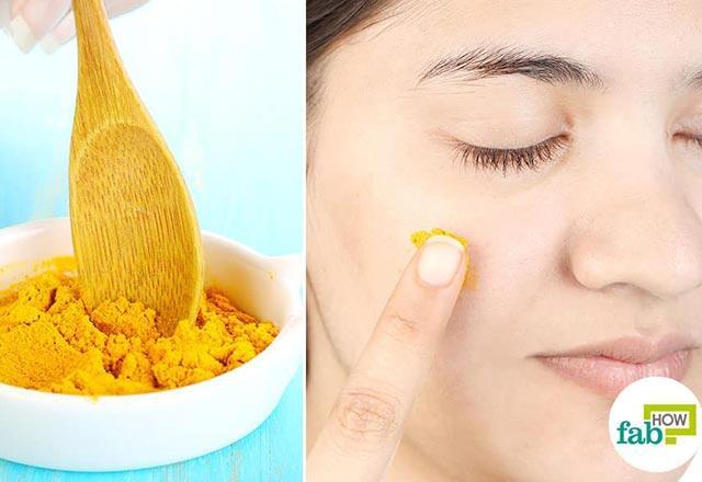 Sivilce nasıl geçer, ne iyi gelir Yüzdeki sivilce izlerine evde bitkisel çözüm önerileri