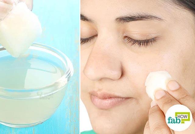 Sivilce nasıl geçer, ne iyi gelir Yüzdeki sivilce izlerine evde bitkisel çözüm önerileri