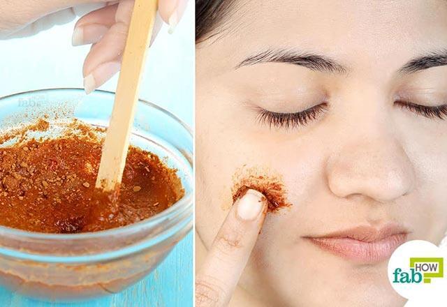 Sivilce nasıl geçer, ne iyi gelir Yüzdeki sivilce izlerine evde bitkisel çözüm önerileri