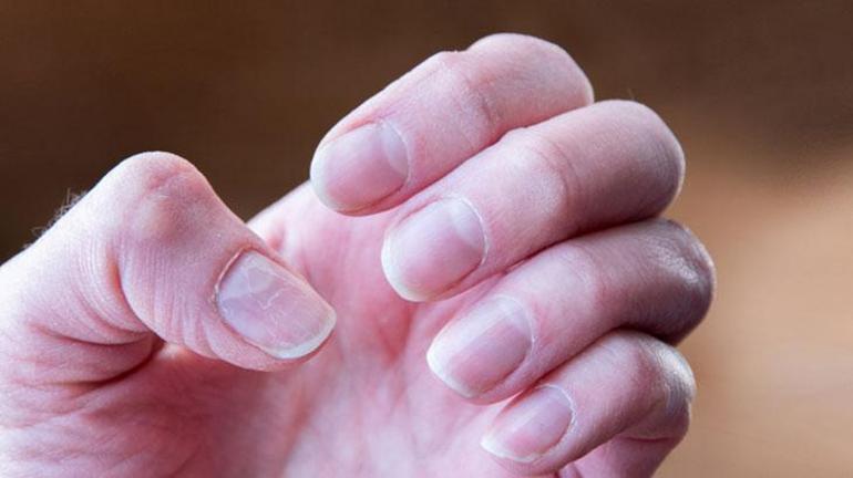 Tırnak kırılmaları ve soyulmalarından bıktıysanız bu kürü deneyin Tırnakları besliyor ve güçlendiriyor