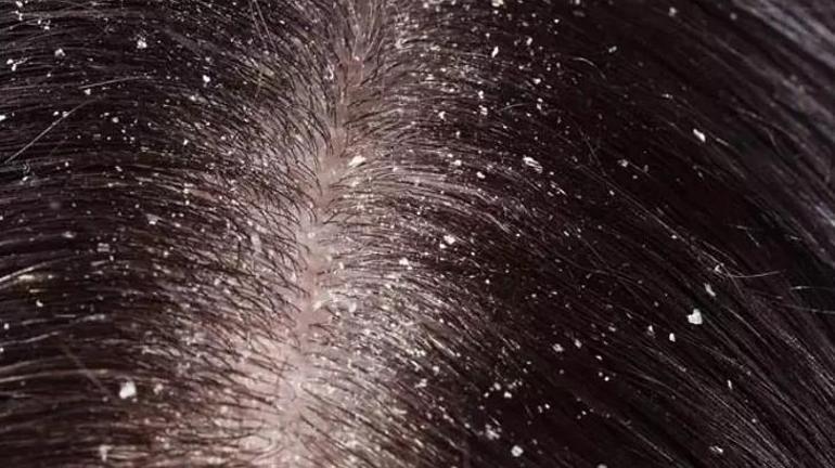 Egzama, kaşıntı kepek problemini kökünden kazıyor… İster şampuana ekleyin ister doğrudan uygulayın