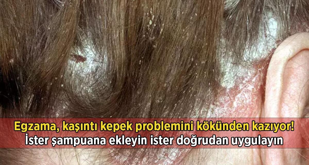 Egzama, kaşıntı kepek problemini kökünden kazıyor… İster şampuana ekleyin ister doğrudan uygulayın