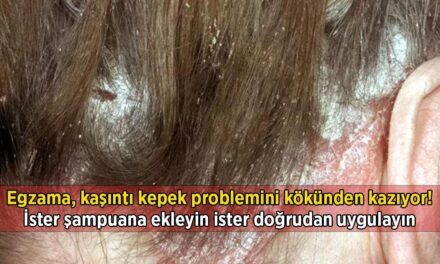 Egzama, kaşıntı kepek problemini kökünden kazıyor… İster şampuana ekleyin ister doğrudan uygulayın