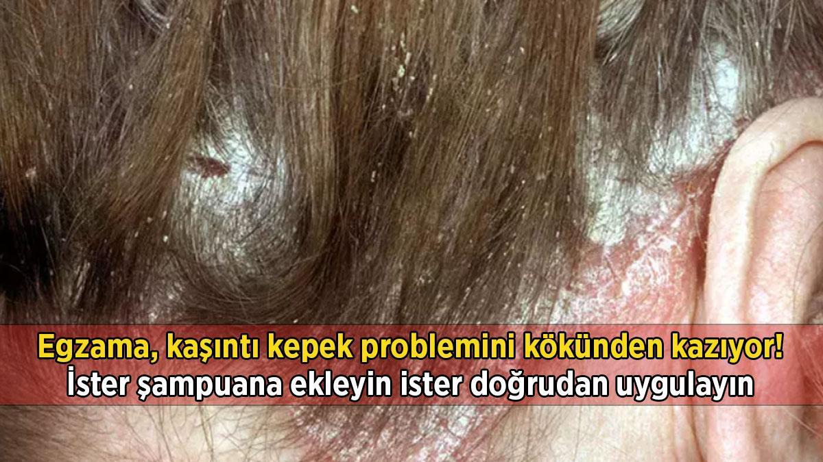 Egzama, kaşıntı kepek problemini kökünden kazıyor… İster şampuana ekleyin ister doğrudan uygulayın
