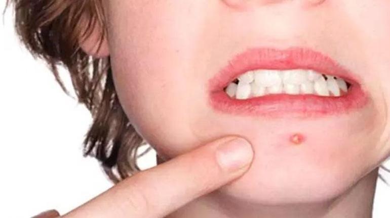 Sivilce ve yara izini yok ediyor Üzerine sürünce etkisini göreceksiniz