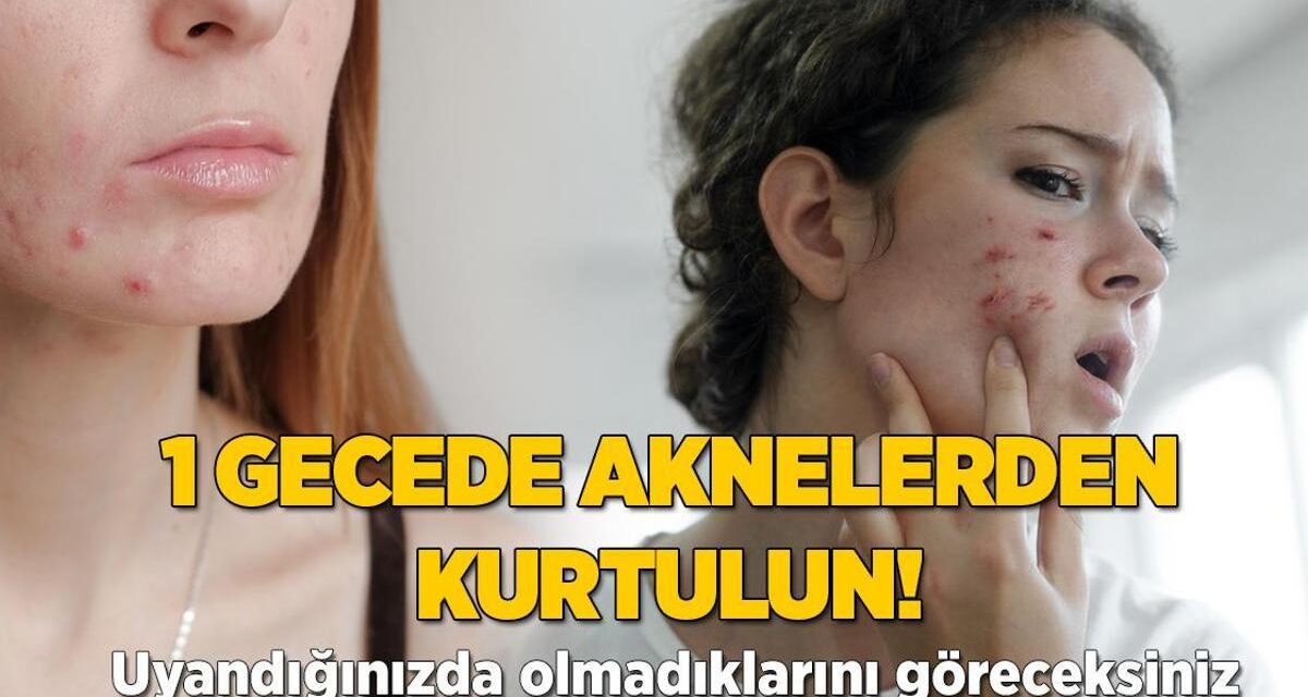 1 gecede yok oluyor! Sivilcelerin üzerine damlatıp uyuyun, aradaki farkı görün