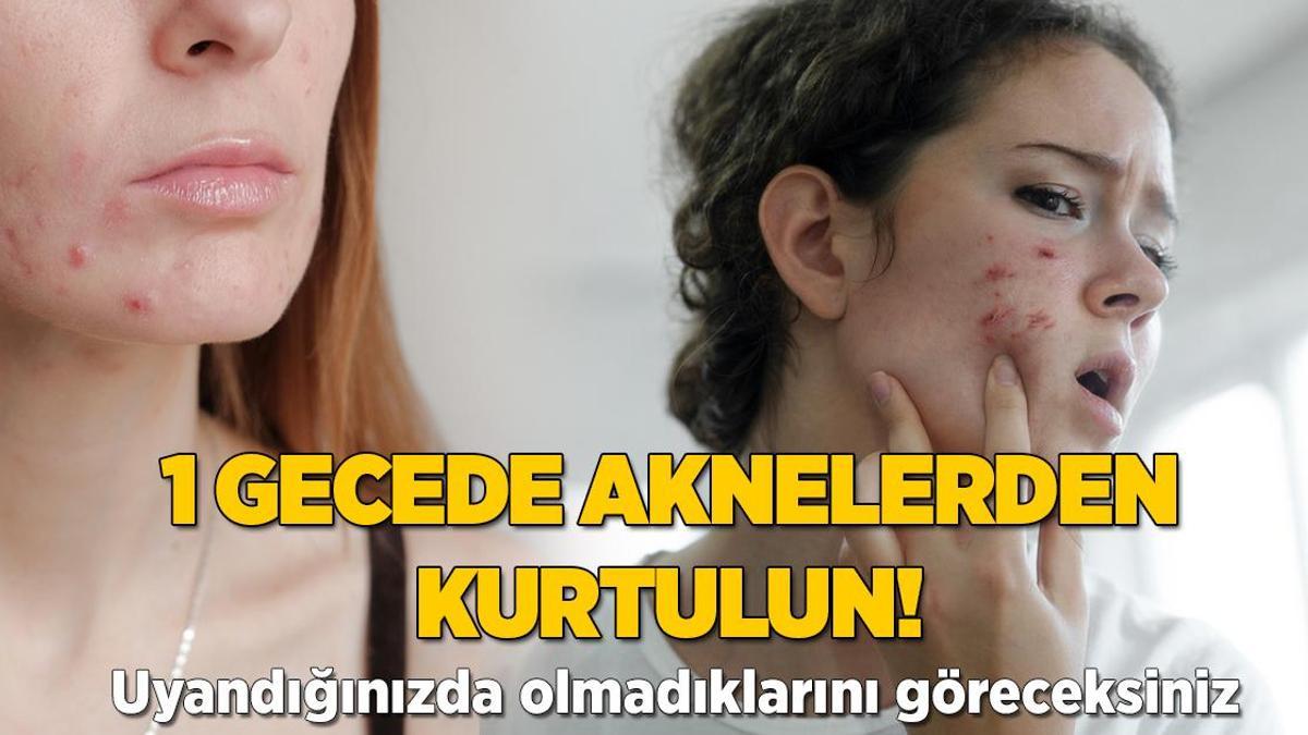 1 gecede yok oluyor! Sivilcelerin üzerine damlatıp uyuyun, aradaki farkı görün