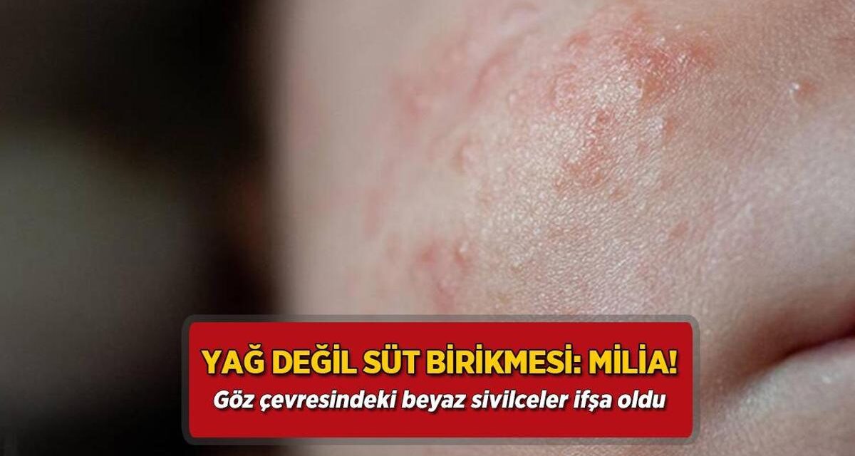 Yağ değil süt birikmesi: Milia! Göz çevresindeki beyaz sivilceler ifşa oldu