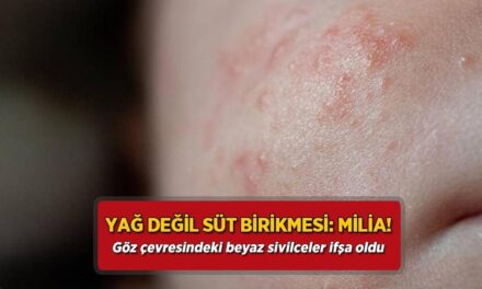 Yağ değil süt birikmesi: Milia! Göz çevresindeki beyaz sivilceler ifşa oldu