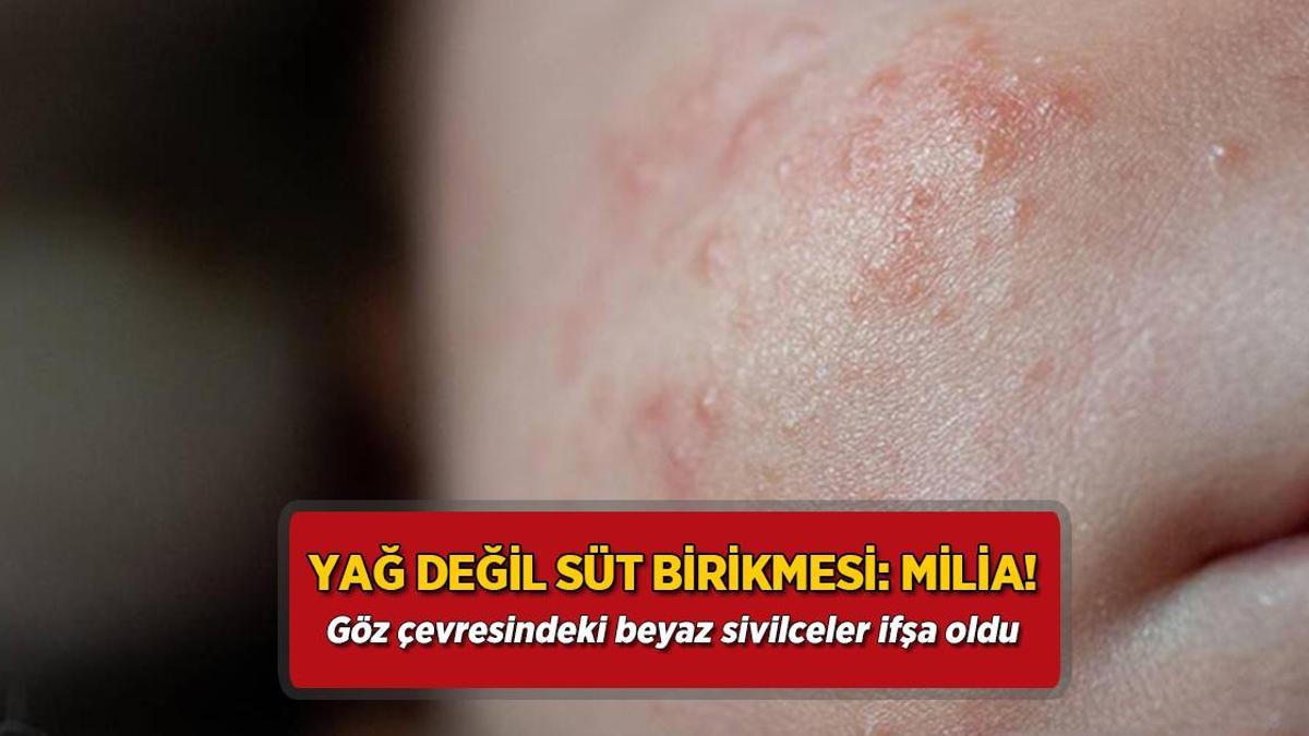 Yağ değil süt birikmesi: Milia! Göz çevresindeki beyaz sivilceler ifşa oldu