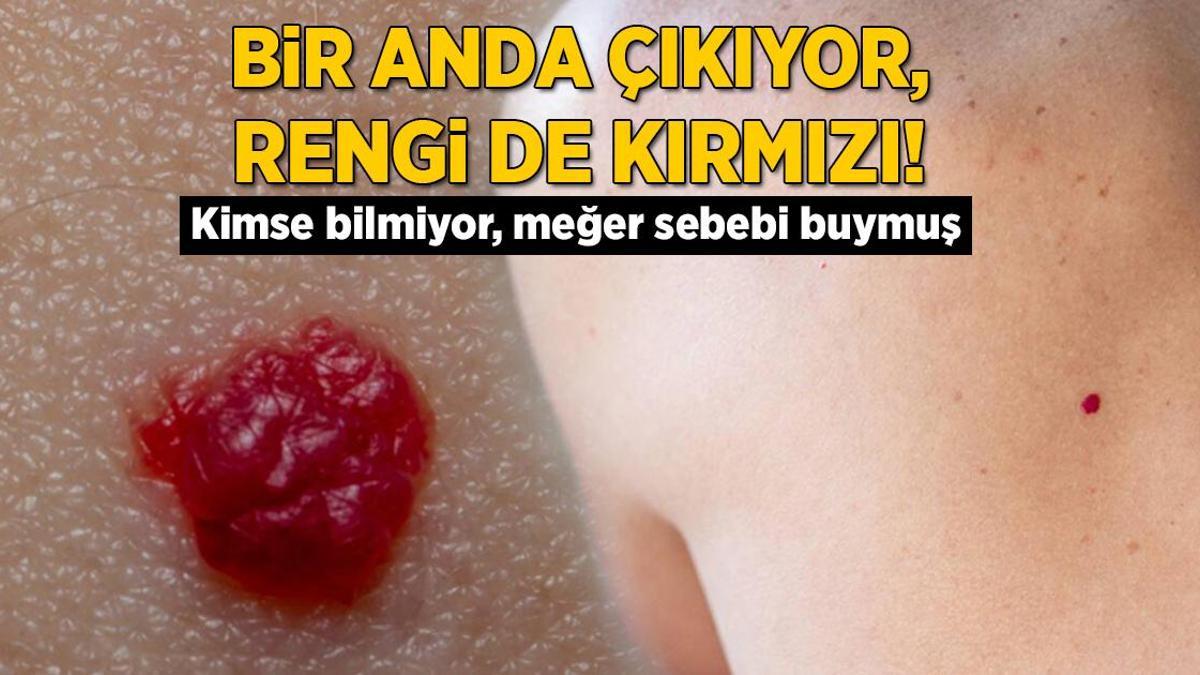 Ciltte bir anda çıkıyor, rengi de kırmızı! Kimse bilmiyor ama meğer sebebi buymuş