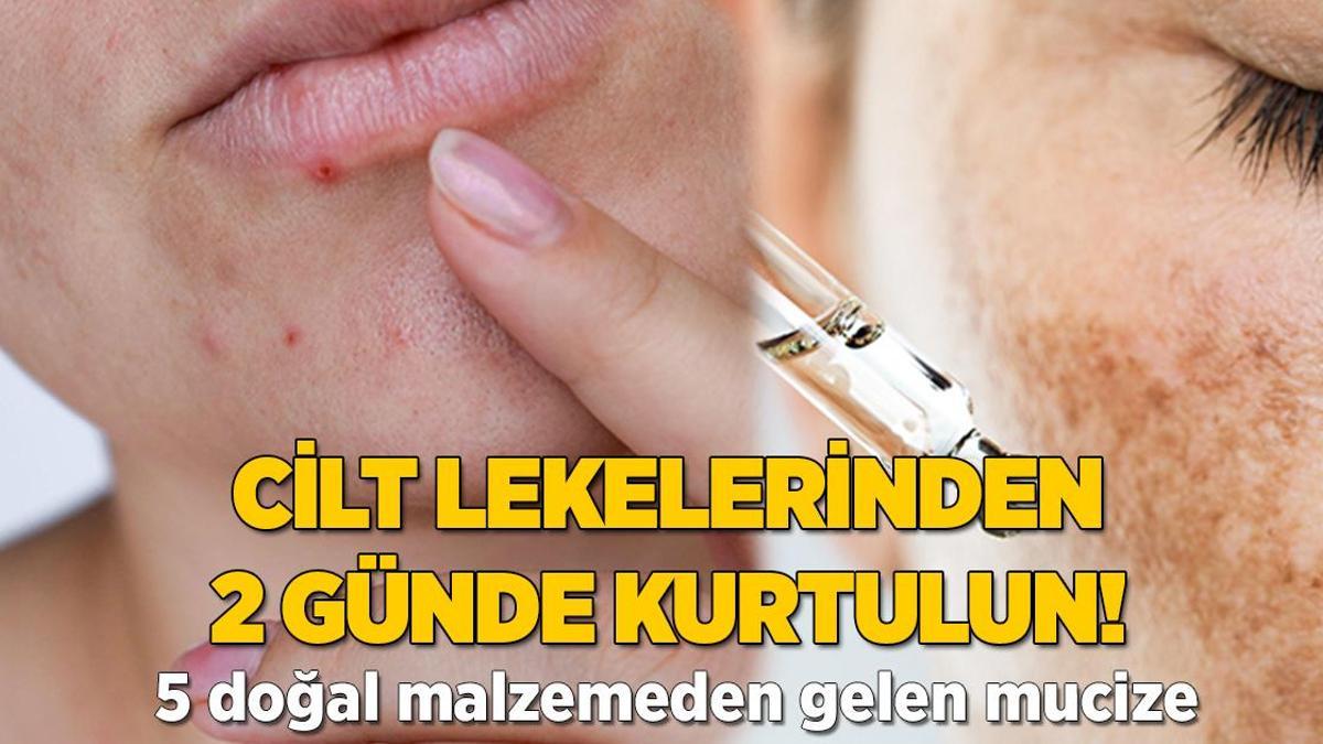 Ciltteki koyu lekelerden 2 günde kurtulun! 5 doğal malzemeden gelen mucize
