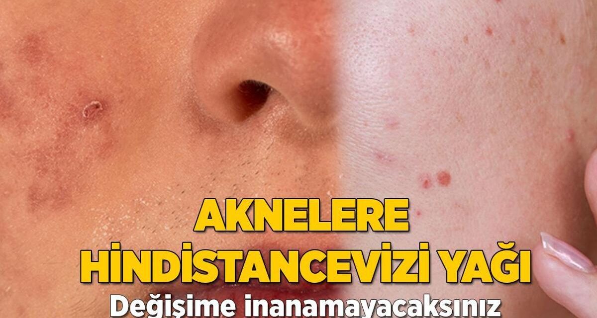 Sivilcelere hindistancevizi yağı! Değişimi kısa sürede göreceksiniz