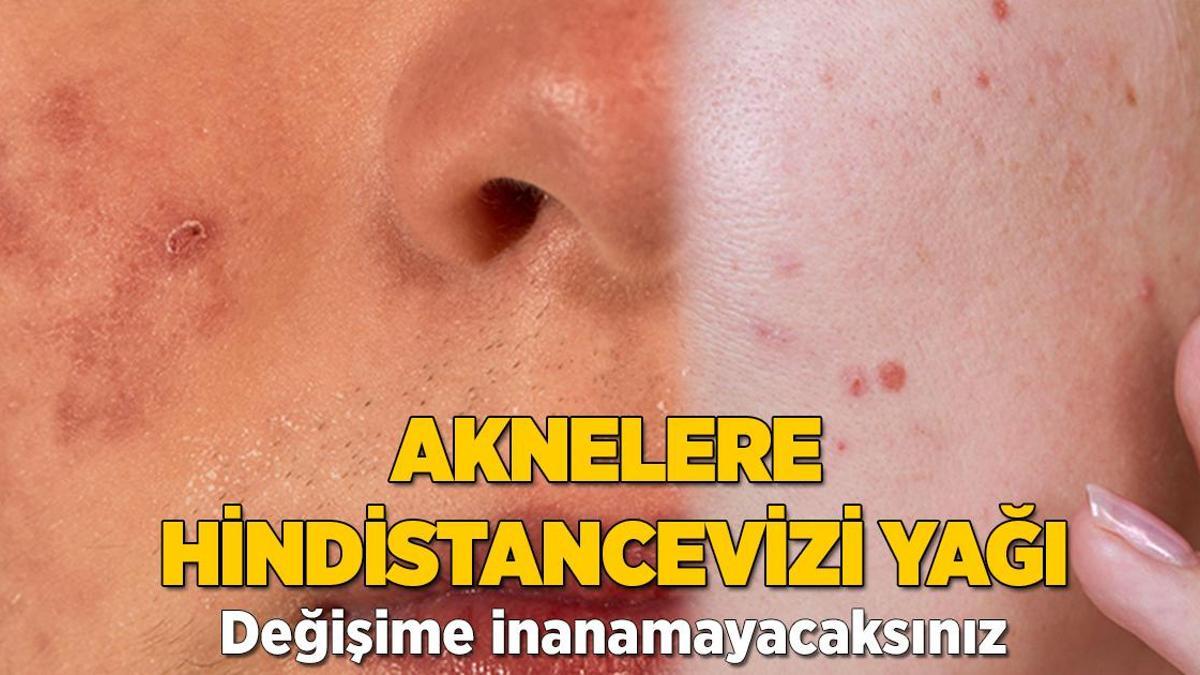 Sivilcelere hindistancevizi yağı! Değişimi kısa sürede göreceksiniz