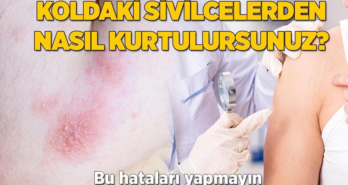 Koldaki sivilcelerden nasıl kurtulursunuz? Gözenek tıkayan bu hataları yapmayın