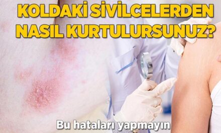 Koldaki sivilcelerden nasıl kurtulursunuz? Gözenek tıkayan bu hataları yapmayın