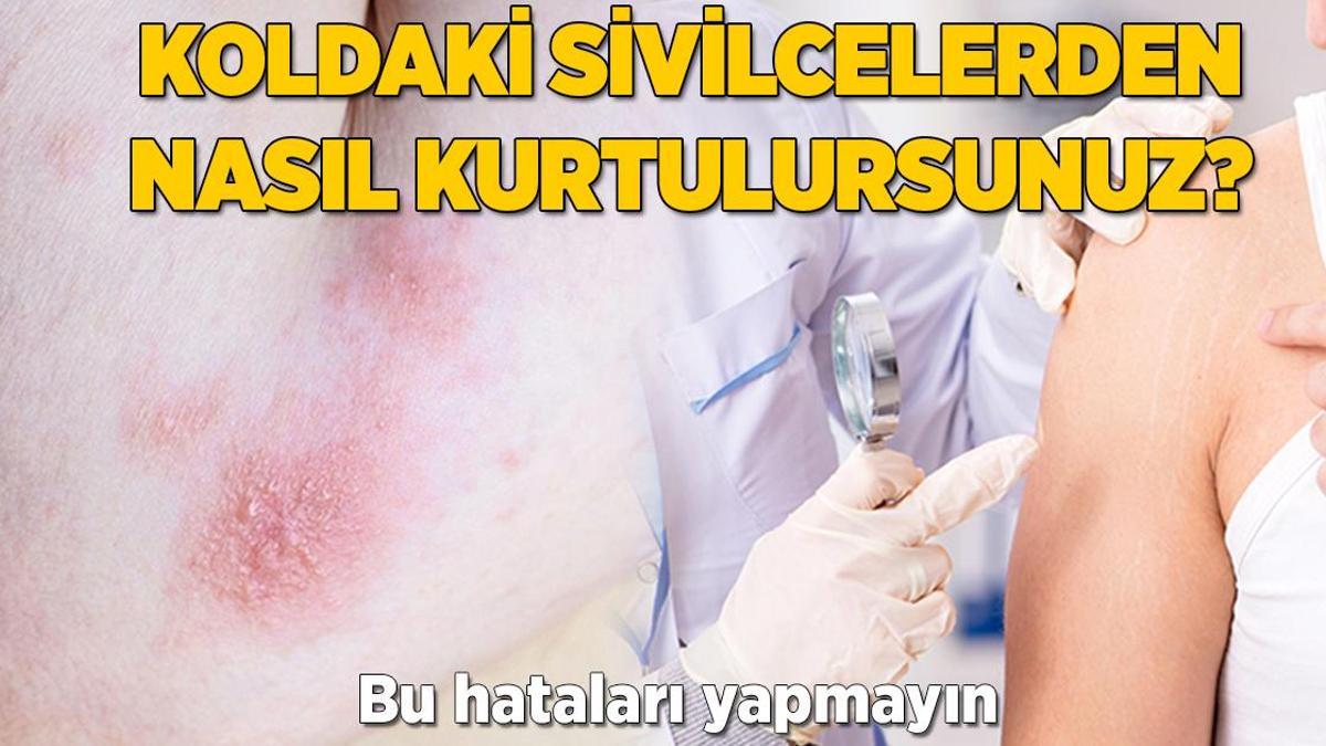 Koldaki sivilcelerden nasıl kurtulursunuz? Gözenek tıkayan bu hataları yapmayın