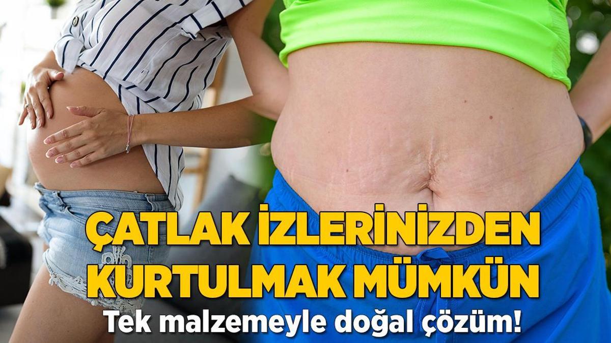 Kilo alıp verdikçe oluşan çatlak izlerine elveda! Her evde varmış, tek malzeme yetiyor
