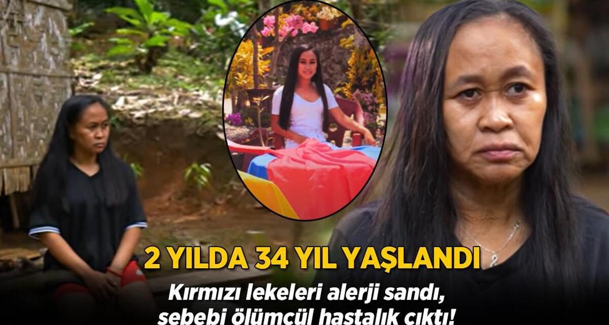 2 senede 34 yıl yaşlandı! Kırmızı lekeleri alerji sandı, sebebi ölümcül çıktı