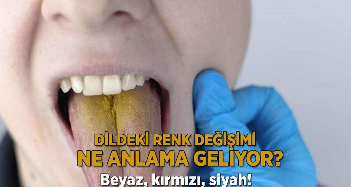 Beyaz, kırmızı, siyah! Dildeki renk değişimi ne anlama geliyor?