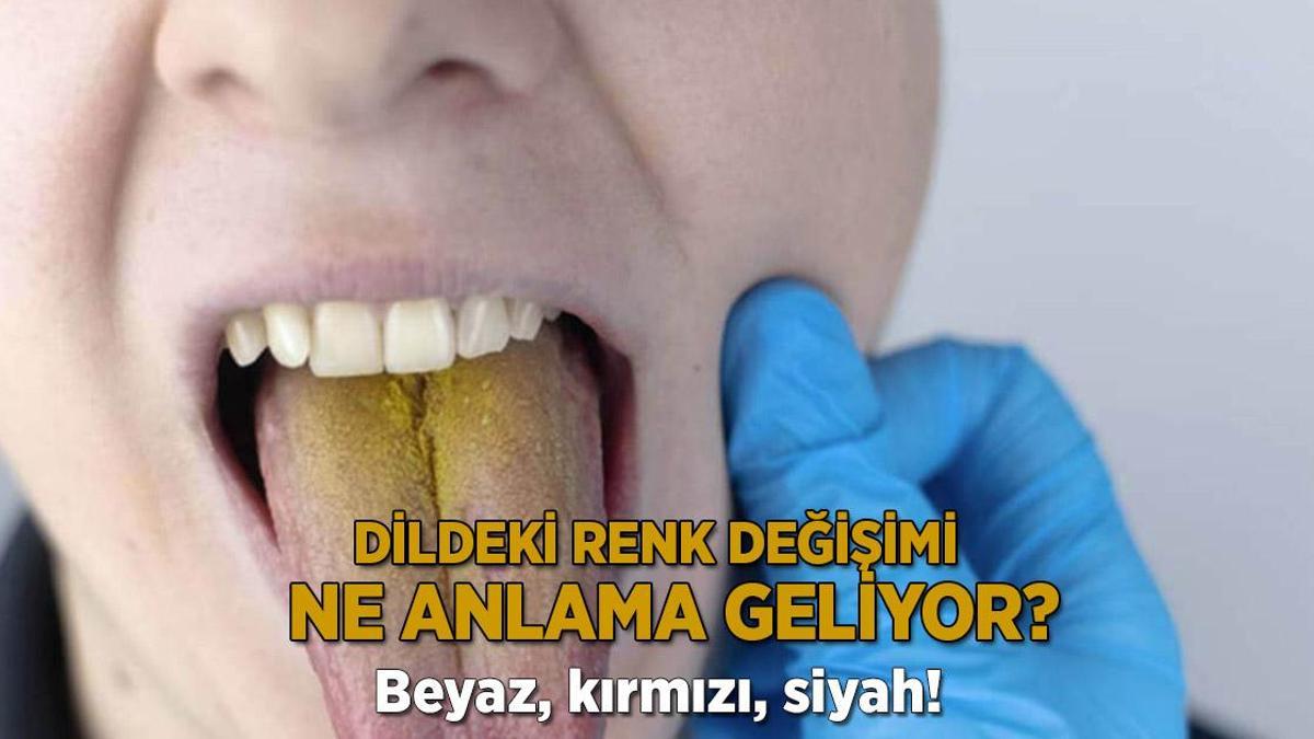 Beyaz, kırmızı, siyah! Dildeki renk değişimi ne anlama geliyor?