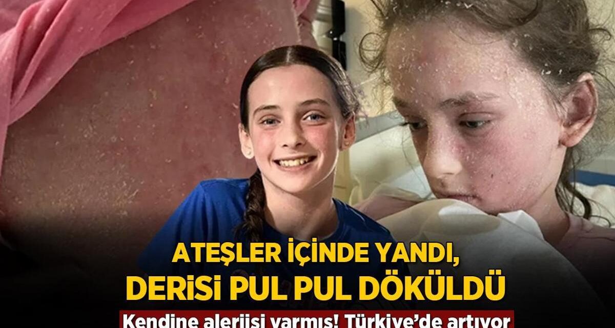 Ateşler içinde yandı, derisi pul pul döküldü! Kendine alerjisi varmış, Türkiye’de artıyor