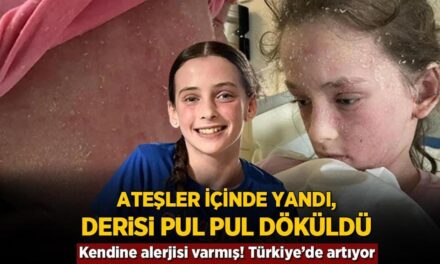 Ateşler içinde yandı, derisi pul pul döküldü! Kendine alerjisi varmış, Türkiye’de artıyor