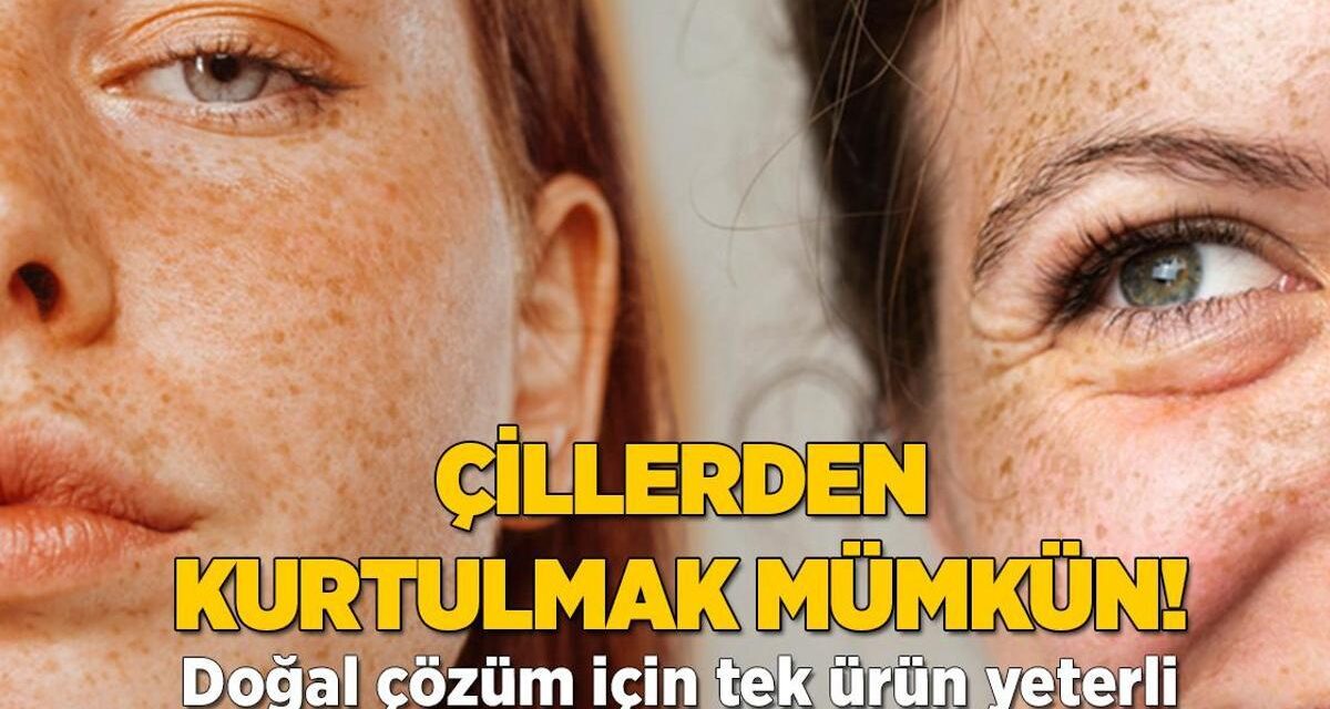 Çilleri adeta silgi gibi siliyor! İçinde kimyasal yok, doğal çözüm için tek ürün