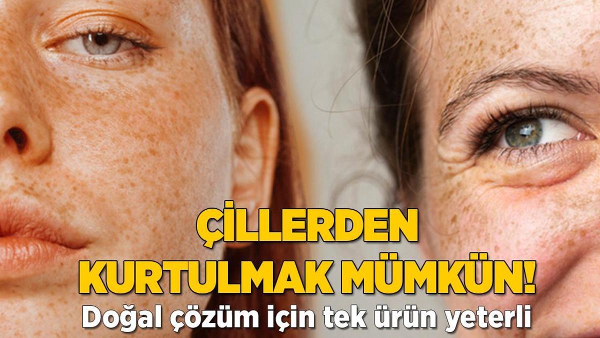Çilleri adeta silgi gibi siliyor! İçinde kimyasal yok, doğal çözüm için tek ürün