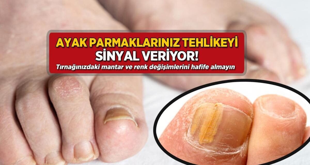 Tırnağınızda mantar ve renk değişimi varsa dikkat! Tehlikeye işaret eden 2 belirti