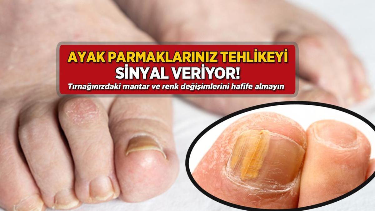 Tırnağınızda mantar ve renk değişimi varsa dikkat! Tehlikeye işaret eden 2 belirti